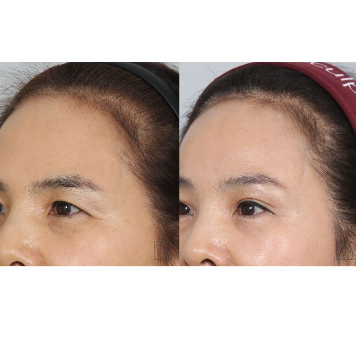 Forehead lift before and after results at Клиника пластической хирургии INIQUÉ, smoother brow area