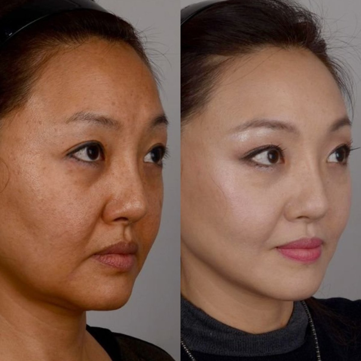 Resultados de lifting facial antes y después en Клиника INIQUÉ, rejuvenecimiento facial