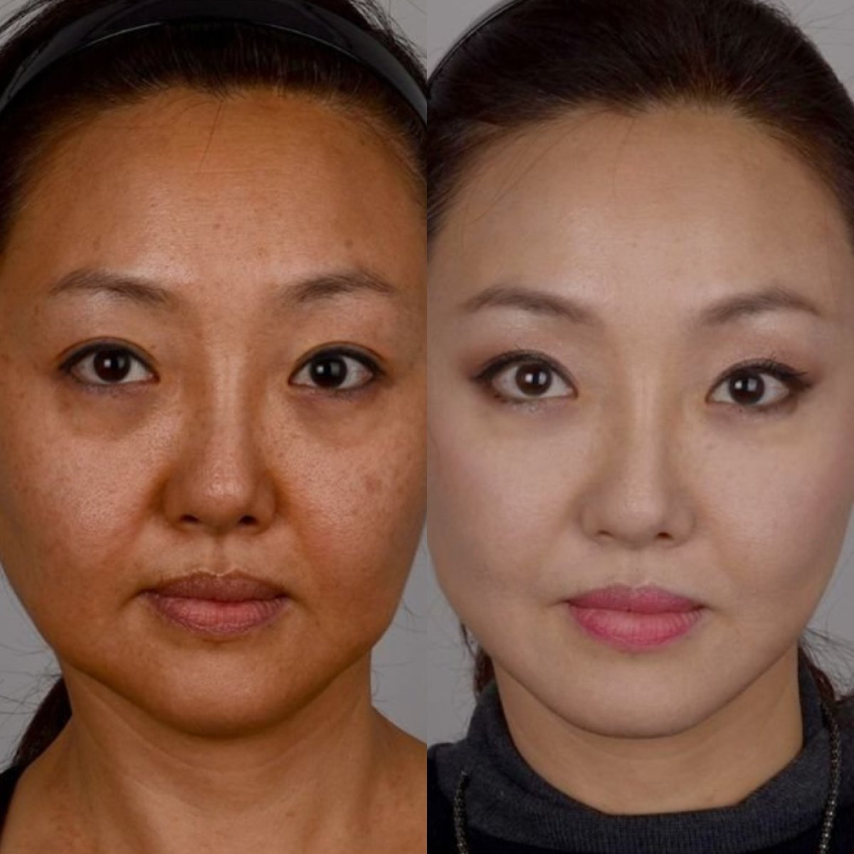 Resultados de lifting facial antes y después en Клиника пластической хирургии INIQUÉ