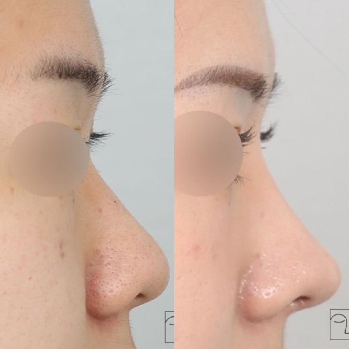 Resultados de rinoplastia antes y después en Клиника INIQUÉ, remodelación de la nariz