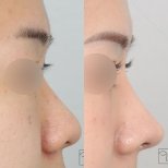 Ergebnisse der Rhinoplastik (Nasenkorrektur) durch Dr. Haewon Yang — Vorher- und Nachher-Fotos des Patienten Fotos vor und nach Rhinoplastik (Nasenkorrektur) durch Dr. Haewon Yang