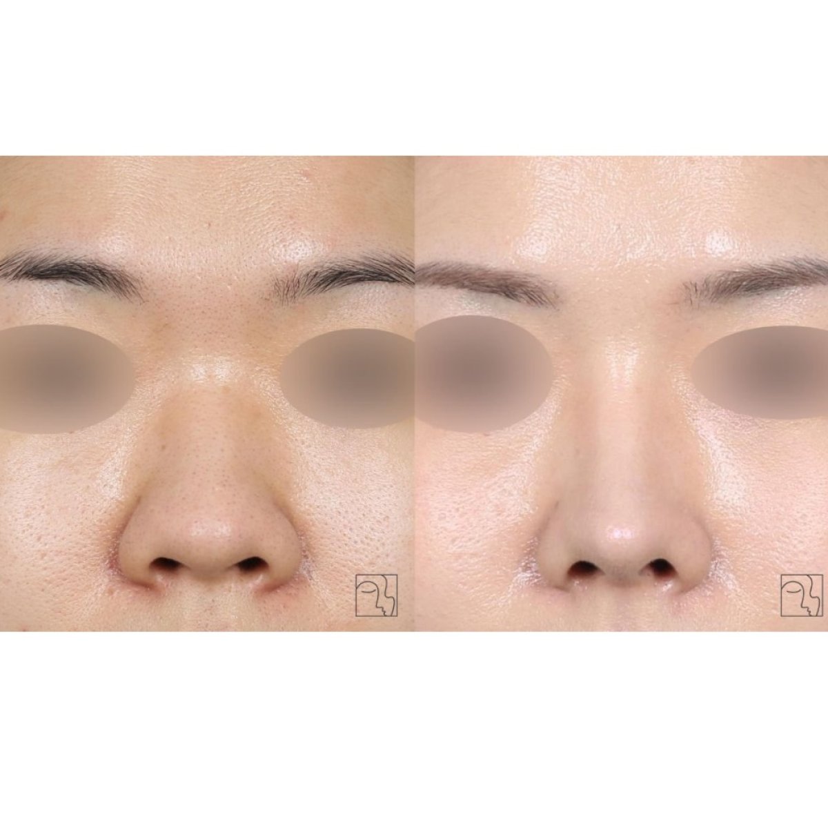 Resultados de rinoplastia antes y después en Клиника пластической хирургии INIQUÉ, remodelación nasal