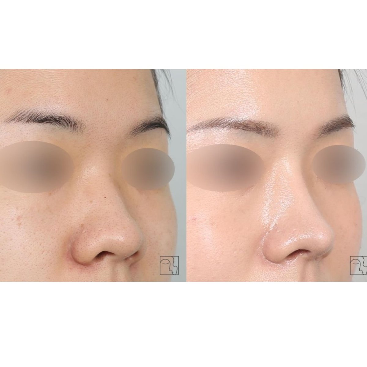 Before and after rhinoplasty results at Клиника пластической хирургии INIQUÉ, nose reshaping
