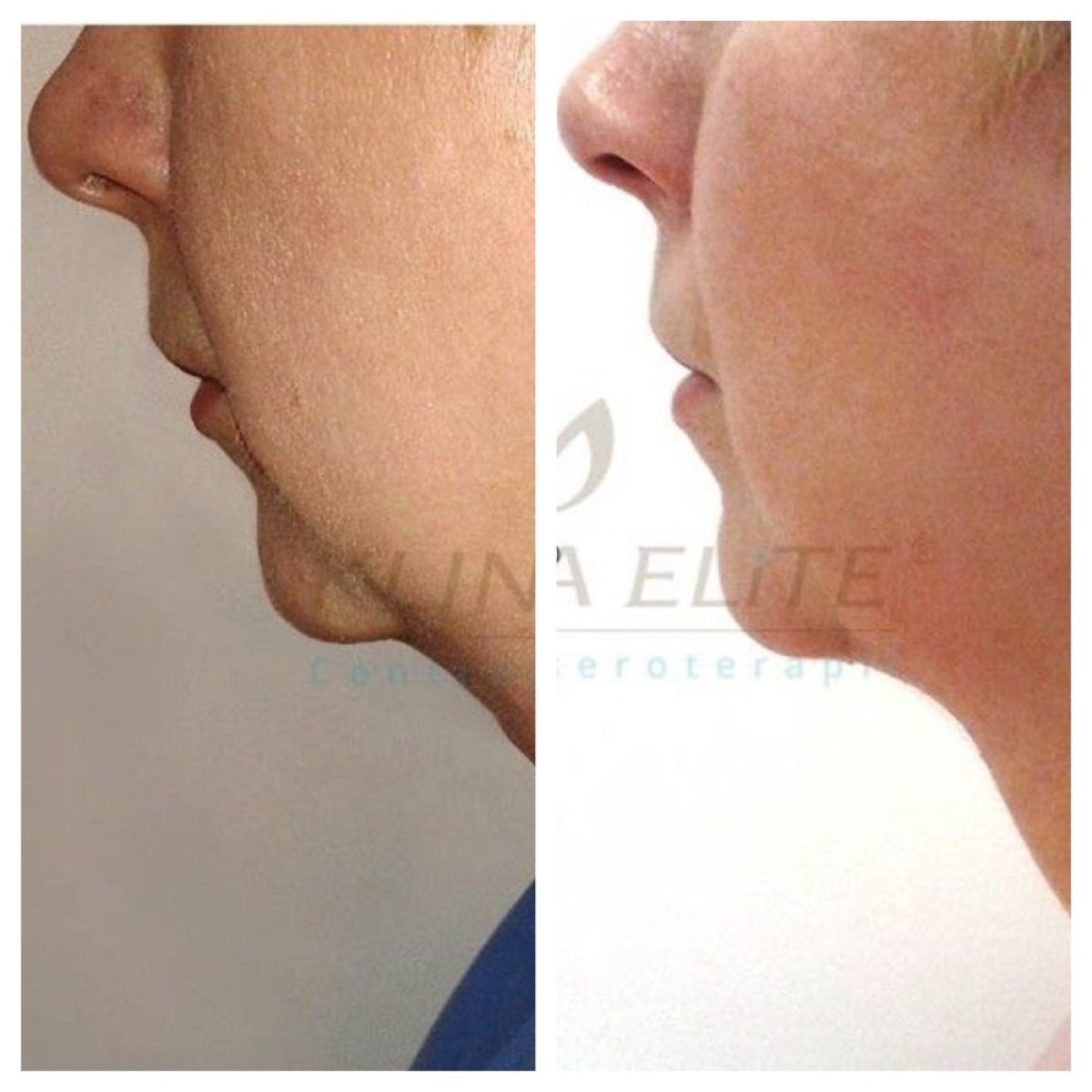 نتائج شفط الدهون للذقن قبل وبعد في Klinika Elite Centrum Laseroterapii
