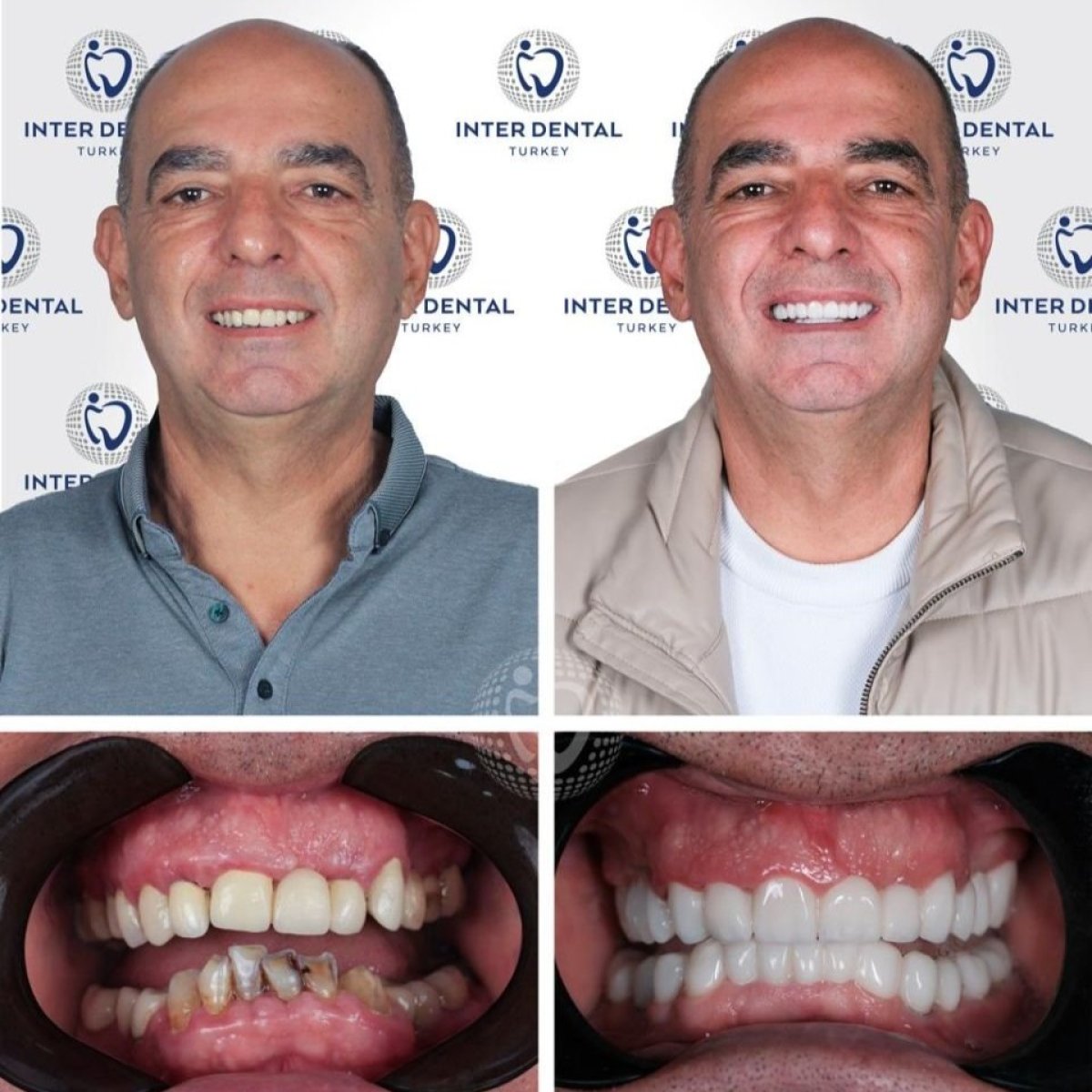 Результаты до и после имплантации зубов в Inter Dental Turkey — восстановление улыбки