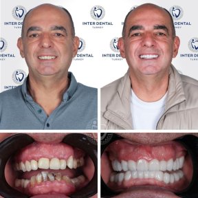 DIO UV (Korea) dental implant installation - photo 4