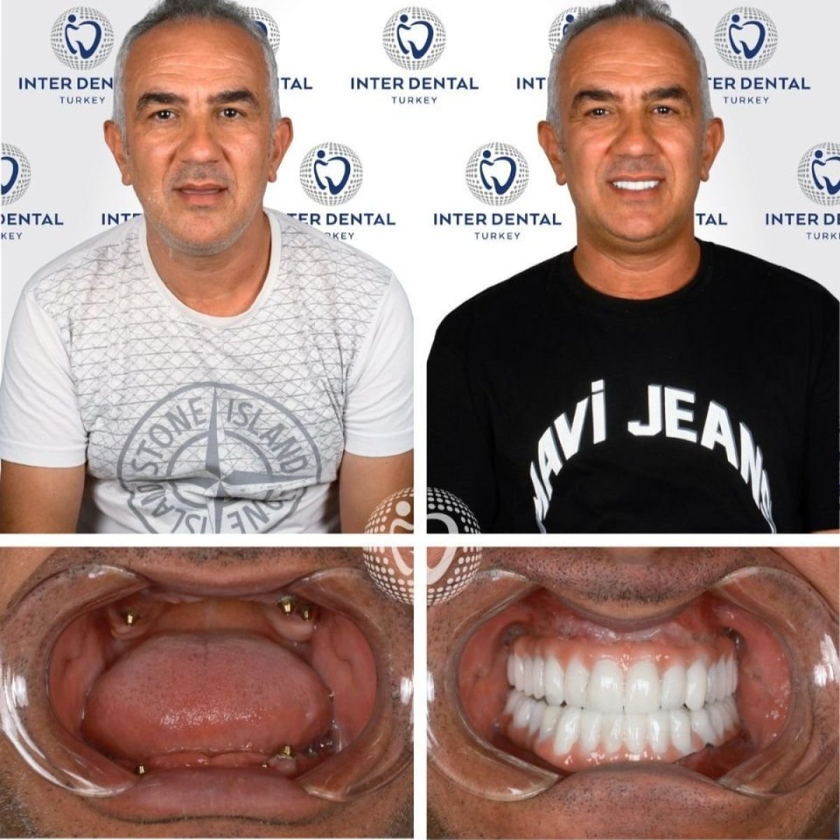 Before and after dental implant results at Inter Dental Turkey – full smile restoration