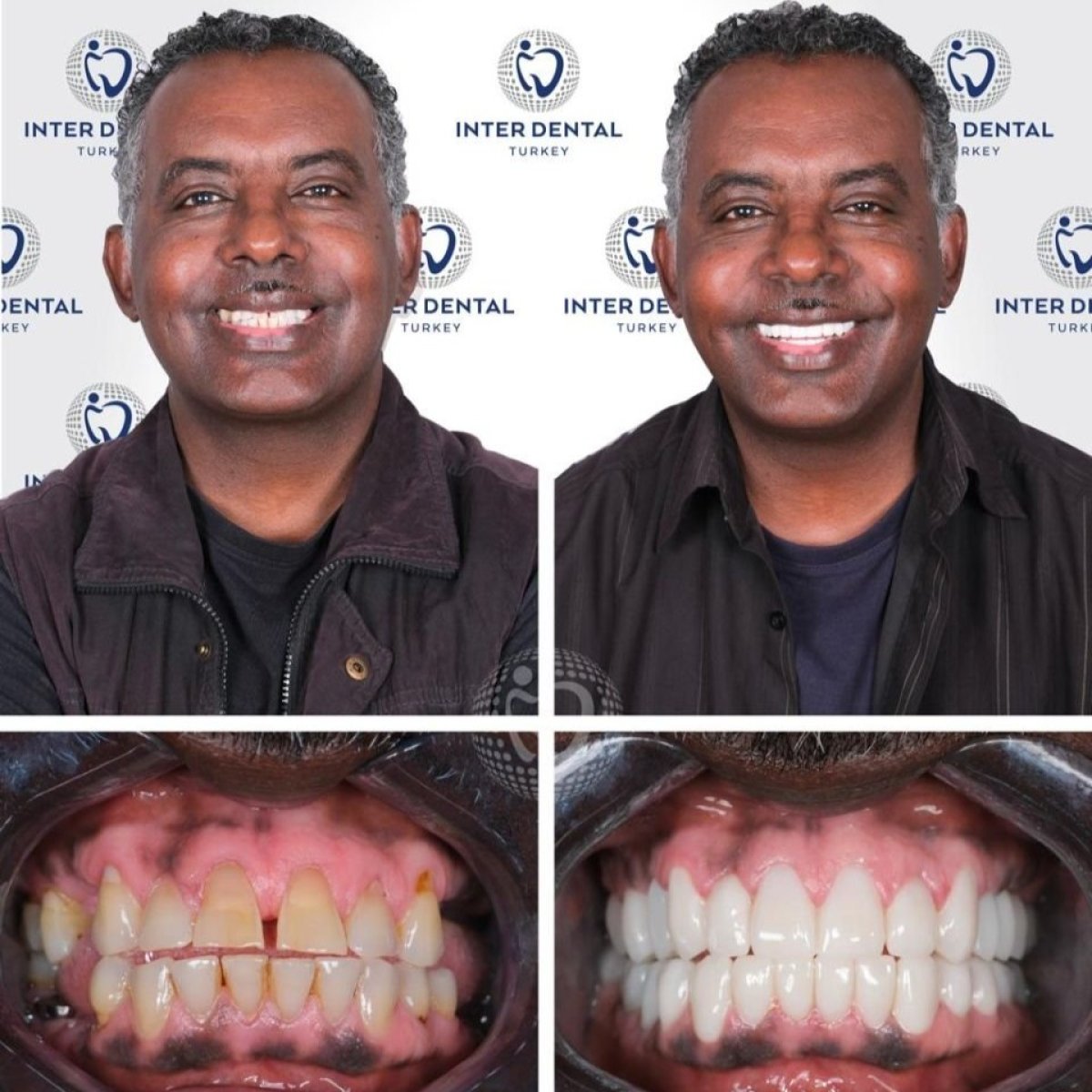 Результаты до и после имплантации зубов в Inter Dental Turkey – улучшение улыбки и прикуса