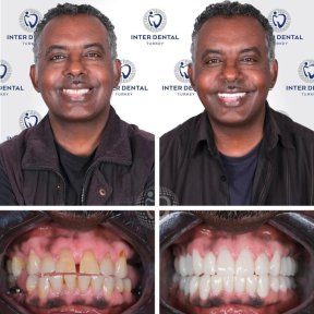 DIO UV (Korea) dental implant installation - photo 5