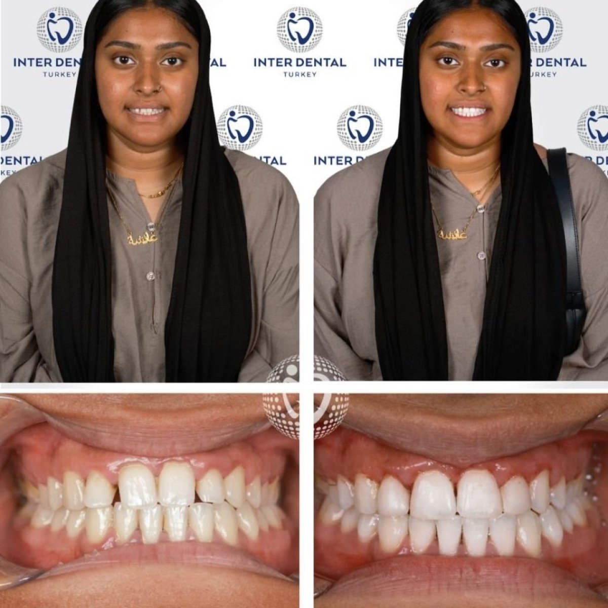 Résultats avant/après restauration dentaire (bonding) chez Inter Dental Turkey, sourire amélioré
