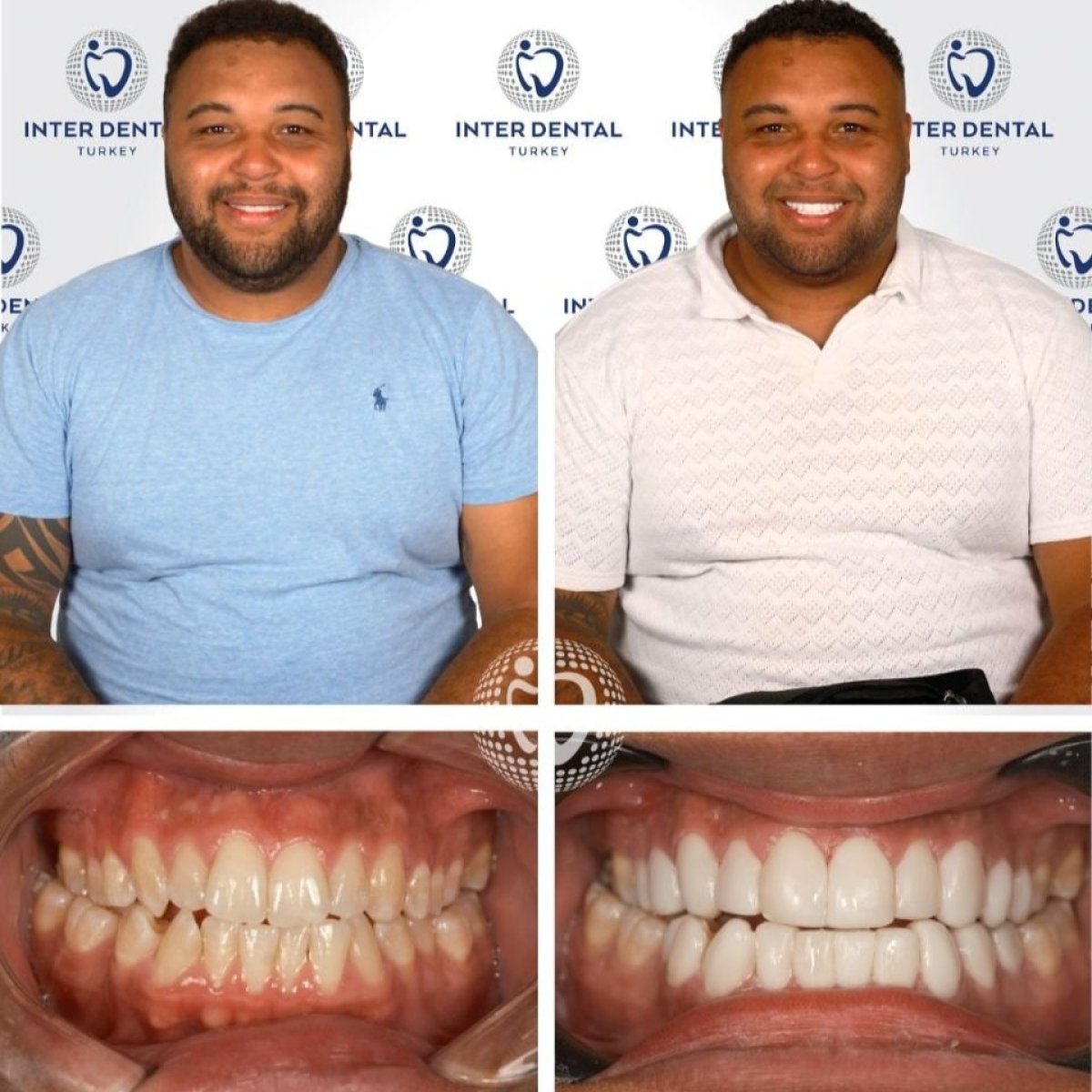 نتائج ترميم الأسنان (الترابط) قبل وبعد في Inter Dental Turkey، ابتسامة محسنة