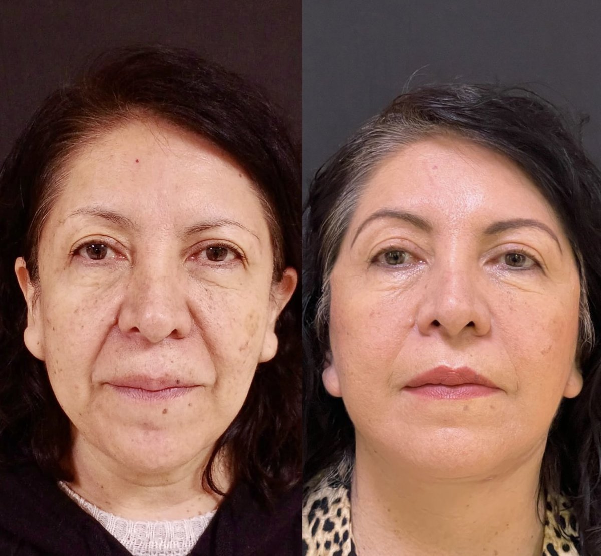 Результаты до и после deep plane facelift – омоложение лица и подтяжка контуров