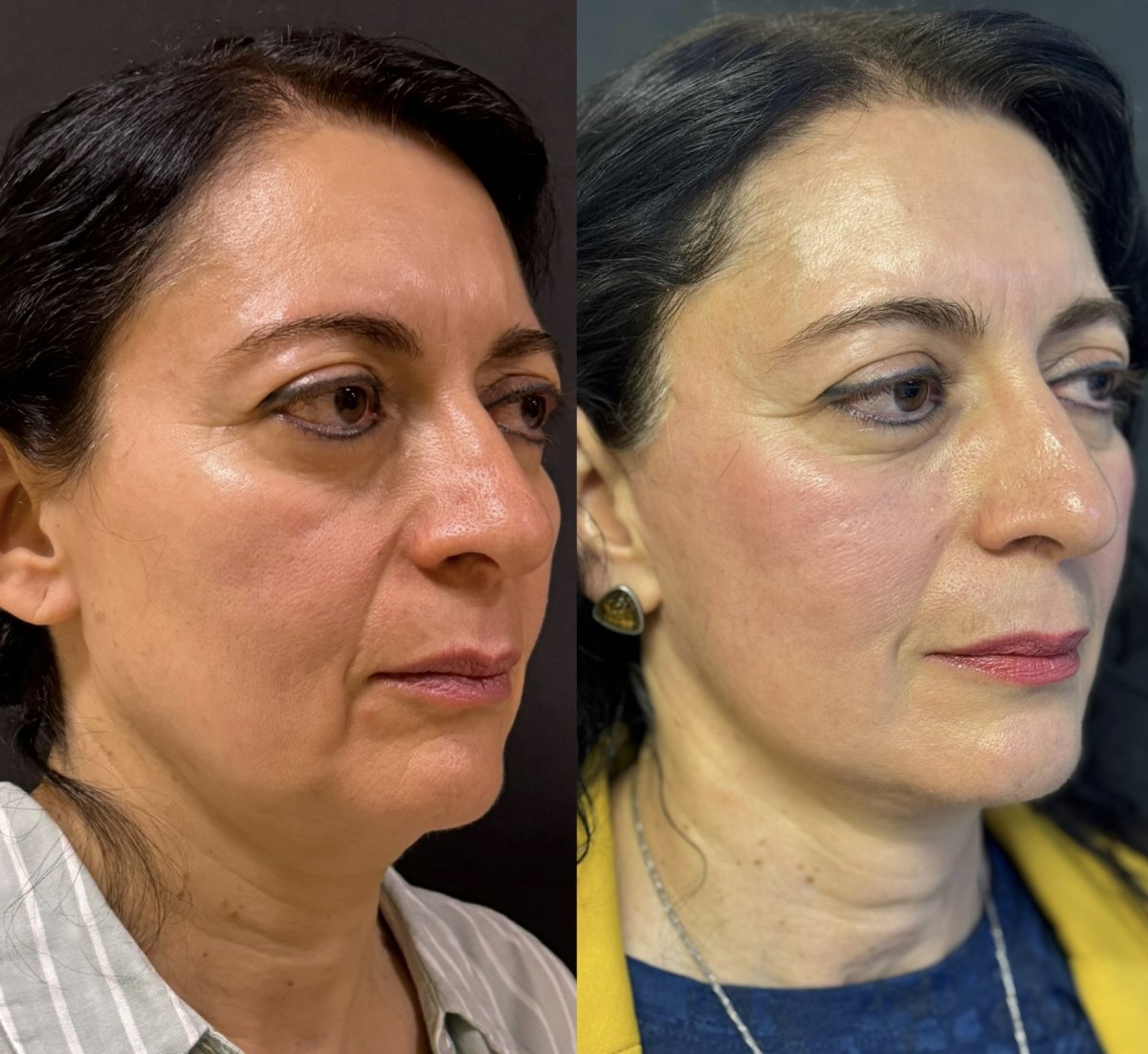 Результаты до и после Deep Plane Facelift – омоложение лица и подтяжка контуров