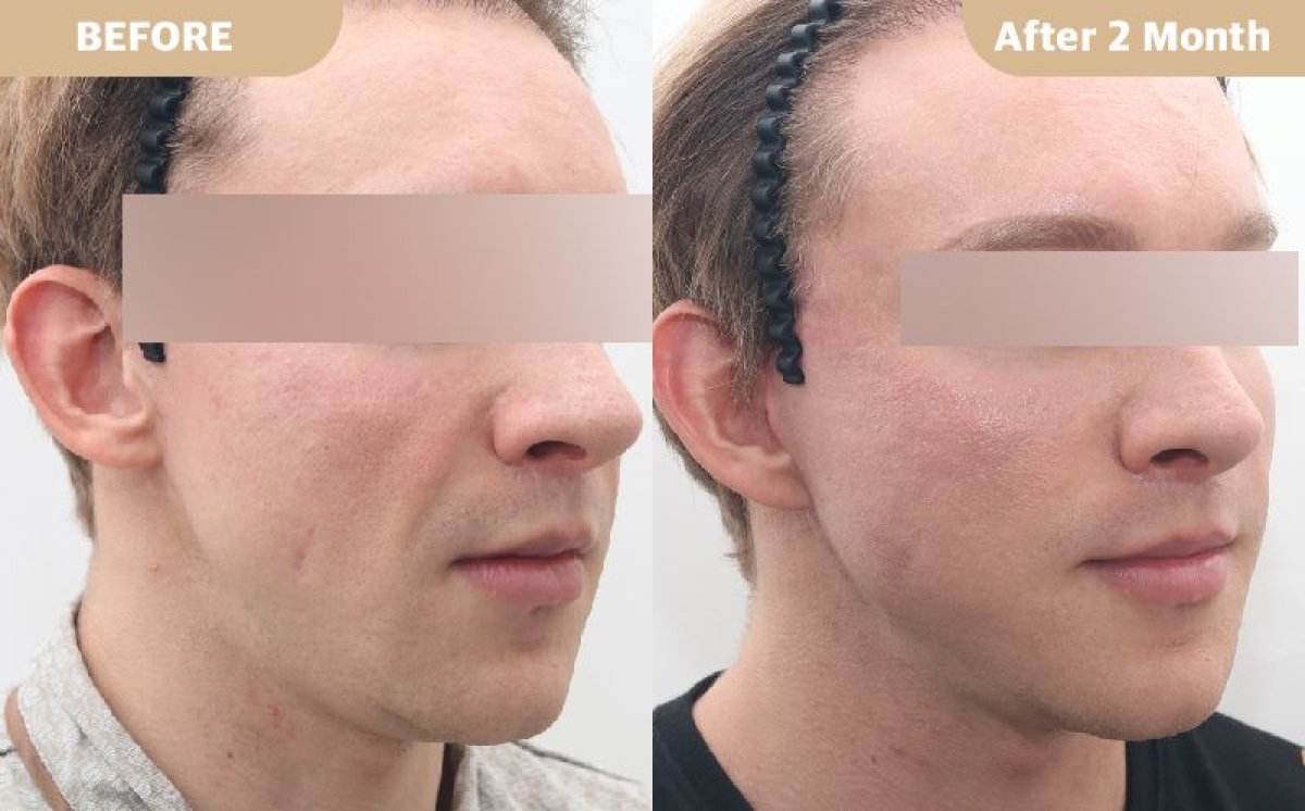 Результаты до и после deep plane SMAS лифтинга в Dr. Tak Plastic Surgery, омоложение лица