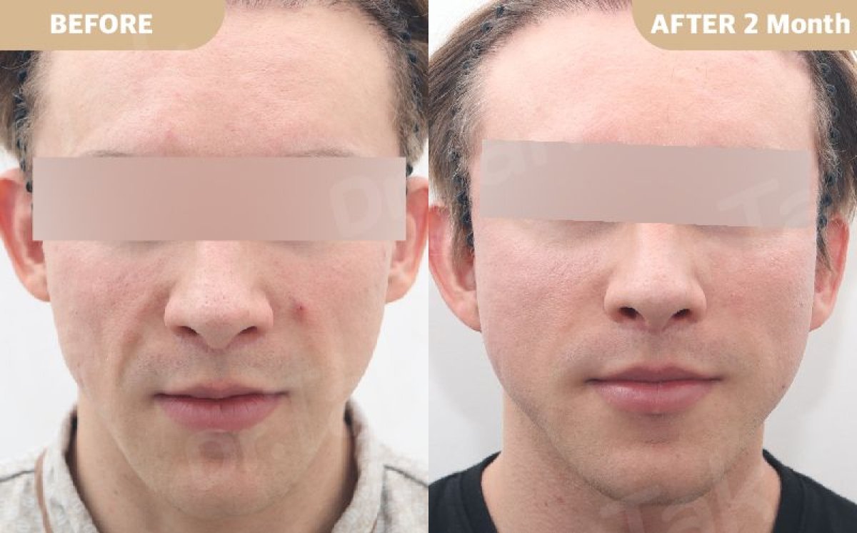 Before and after Deep Plane Facelift results at Dr. Tak Plastic Surgery, visible facial rejuvenation