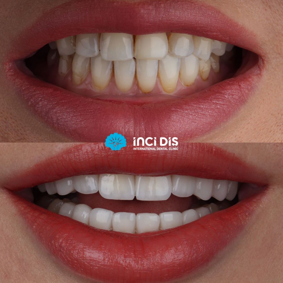 Before and after veneers at Inci Dis International, smile makeover with natural white teeth result