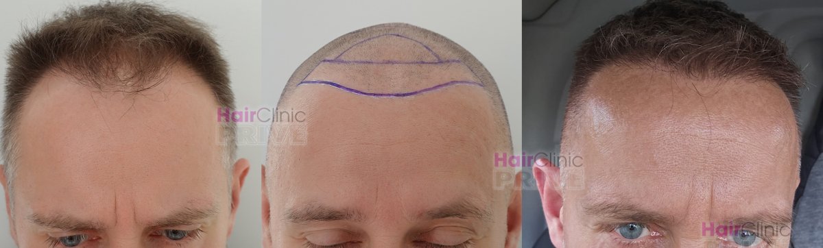 Результати пересадки волосся FUE до і після в Hair Clinic PRIVÉ, відновлена лінія росту