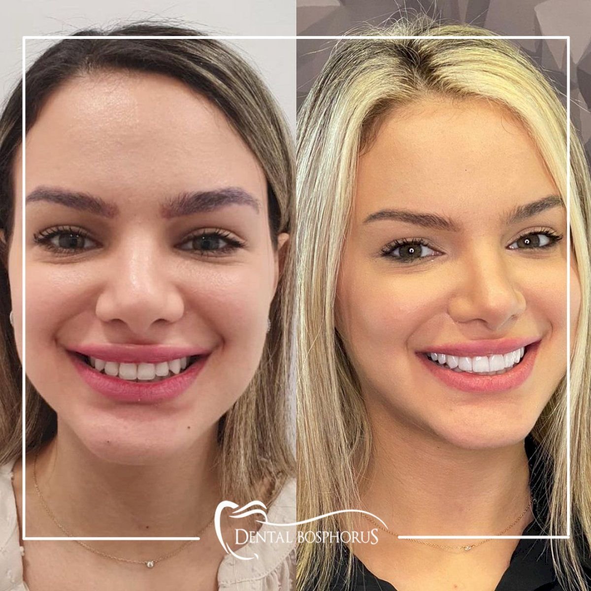 Результаты до и после Hollywood Smile в Dental Bosphorus, видимое преображение улыбки