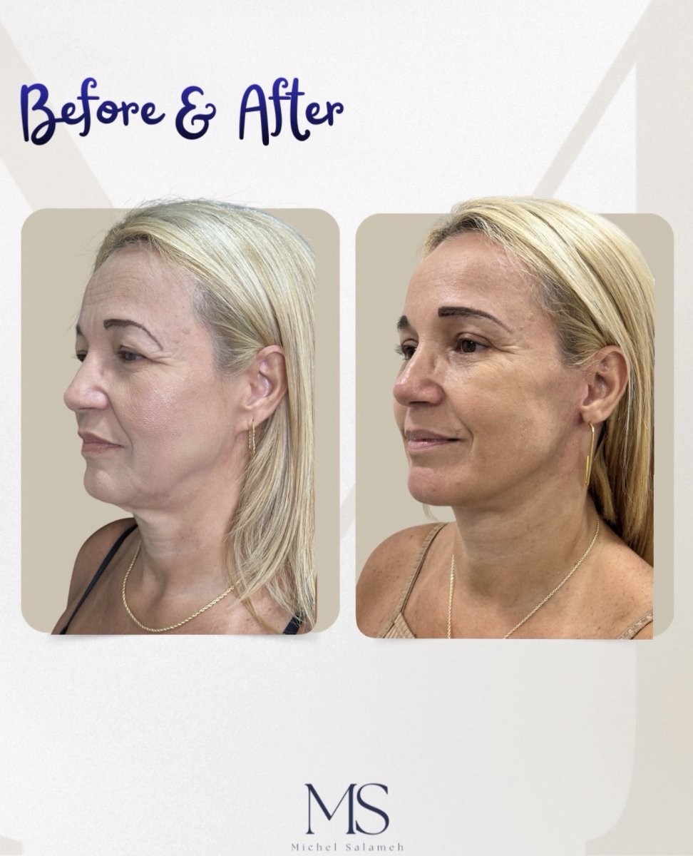 Результат до и после deep plane подтяжки лица в Dr. Michel Salameh - Plastic And Aesthetic Surgery