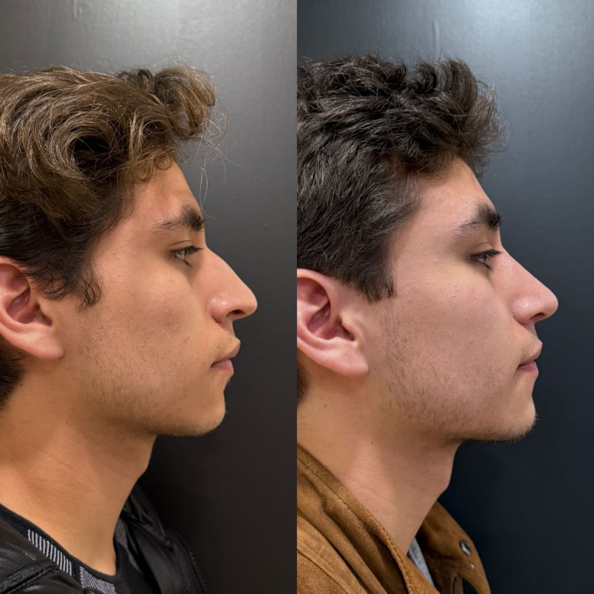 Before and after revision rhinoplasty results at Dr. Alexandro Aguilera - Plastic Surgery clinic