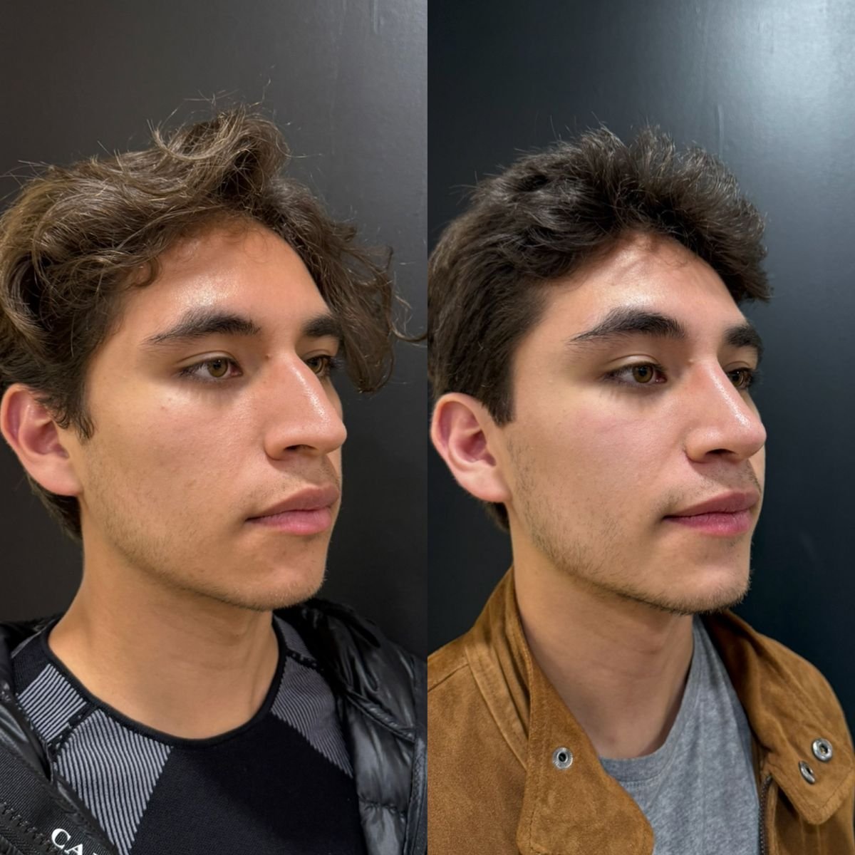 Результаты до и после риносептопластики в клинике Dr. Alexandro Aguilera - Plastic Surgery