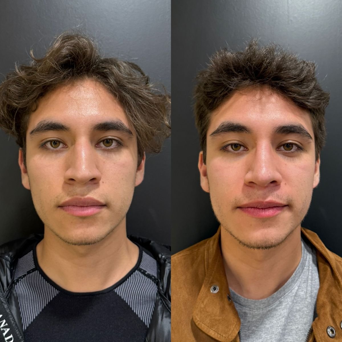 Before and after revision rhinoplasty results at Dr. Alexandro Aguilera - Plastic Surgery clinic