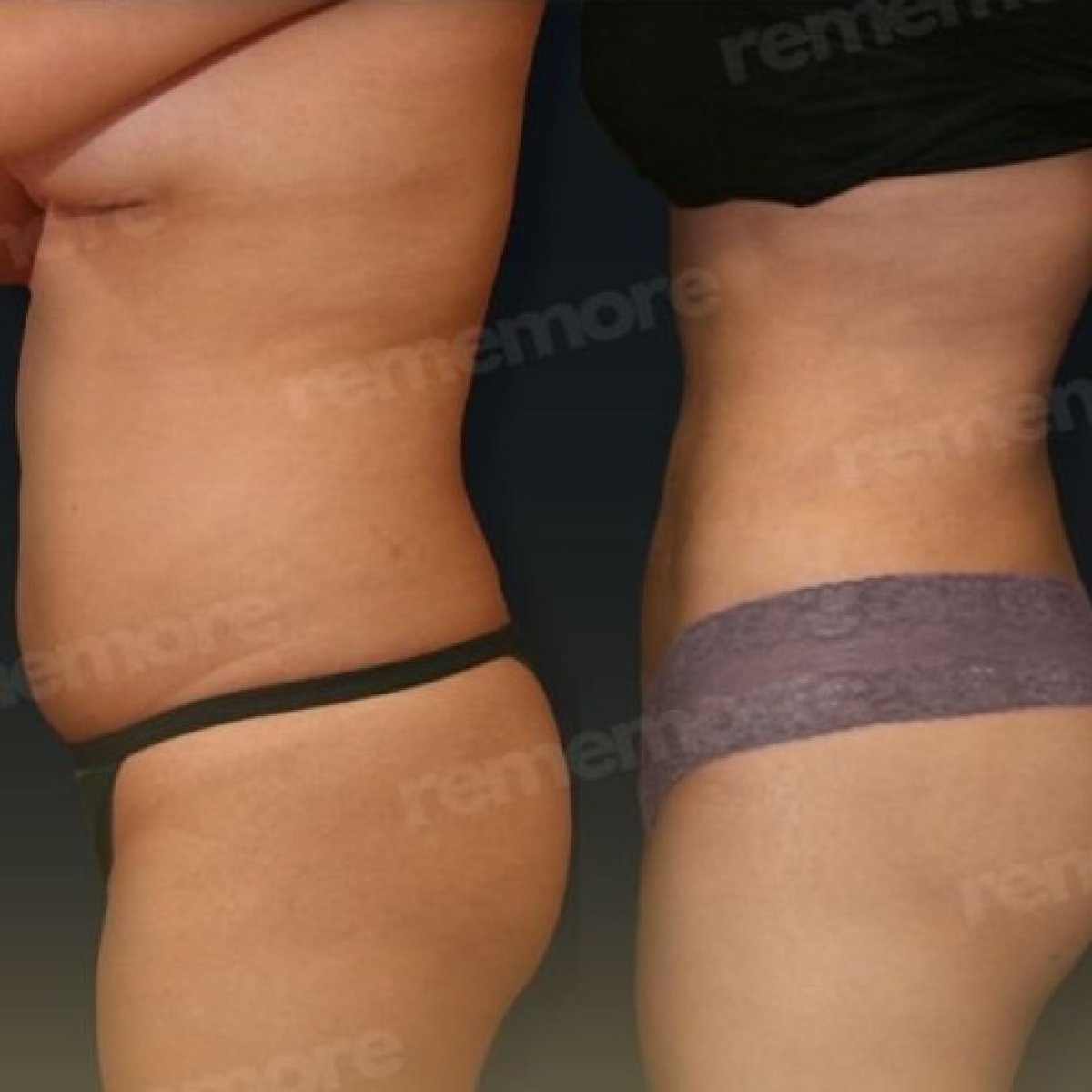 Efekty liposukcji brzucha przed i po w Memorial Antalya Hospital, szczuplejsza talia