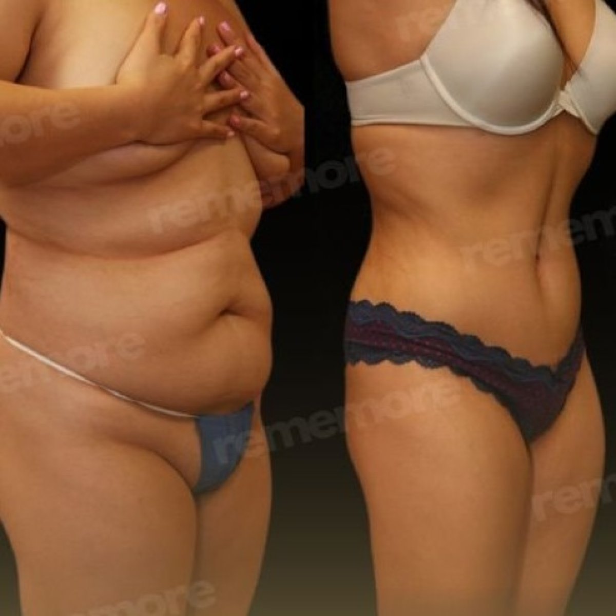 Before and after abdominal liposuction results at Memorial Antalya Hospital, slimmer waistline
