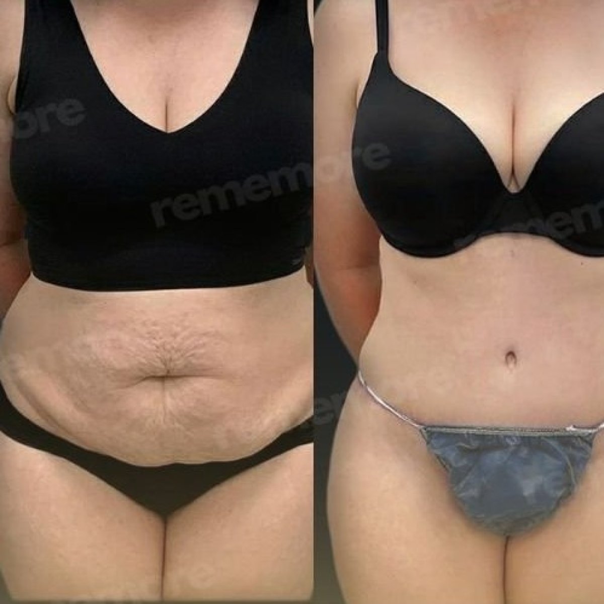 Before and after abdominal liposuction results at Memorial Antalya Hospital, flatter stomach