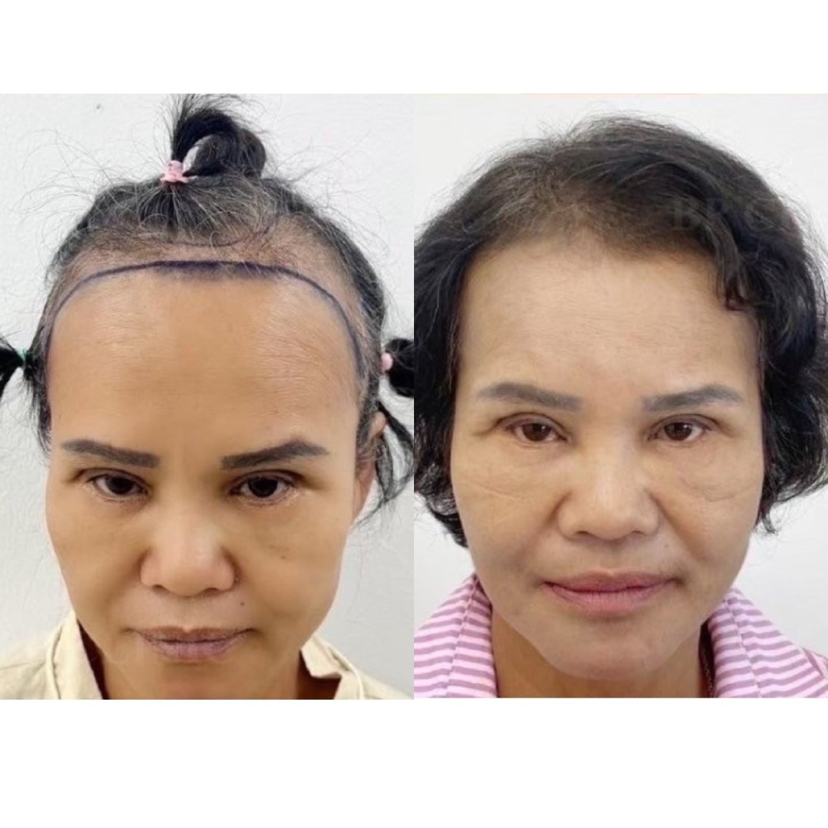 Before and after hair transplant results at Somchai Clinic, restored hairline and fuller hair