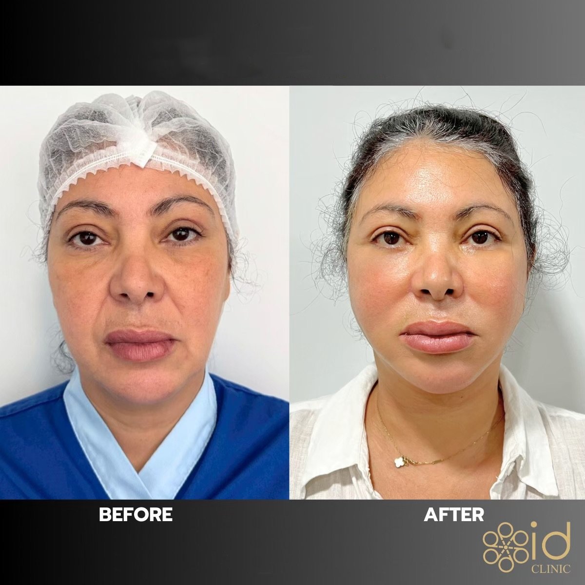 Before and after facial fat transfer results at ID Clinic Bangkok, enhanced facial volume