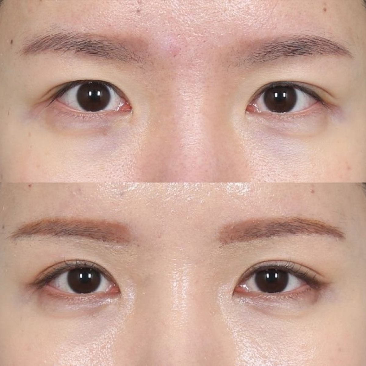 Resultados de lifting de cejas antes y después en Клиника пластической хирургии INIQUÉ