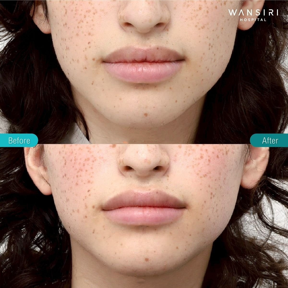Resultados de lip lift antes y después en Wansiri Hospital, mayor contorno y volumen labial