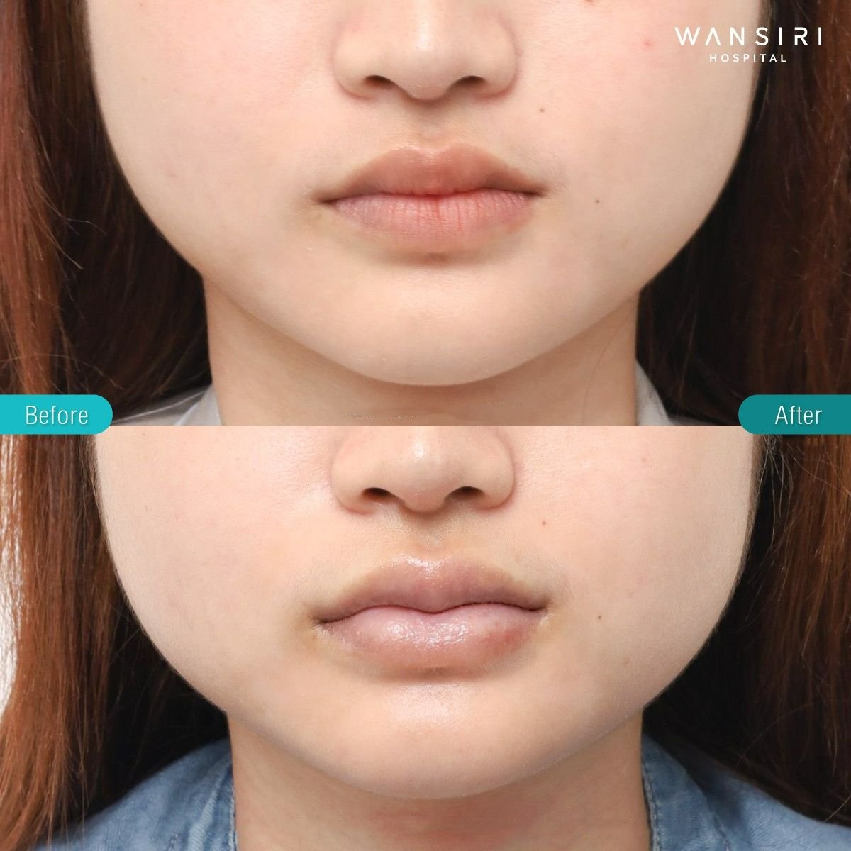 Resultados antes y después de lip lift en Wansiri Hospital, contorno labial mejorado