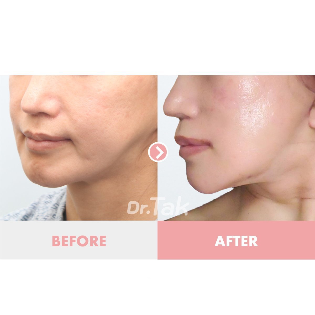 نتائج شد الوجه العميق قبل وبعد في عيادة Dr. Tak Plastic Surgery، تحديد الفك بوضوح