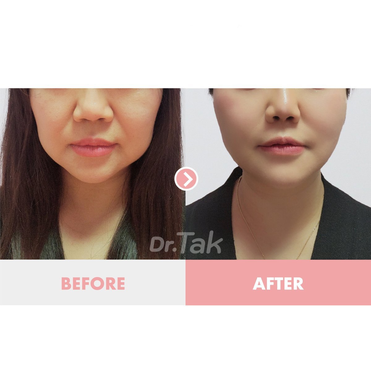 نتائج شد الوجه العميق قبل وبعد في عيادة Dr. Tak Plastic Surgery، تحسين ملامح الوجه