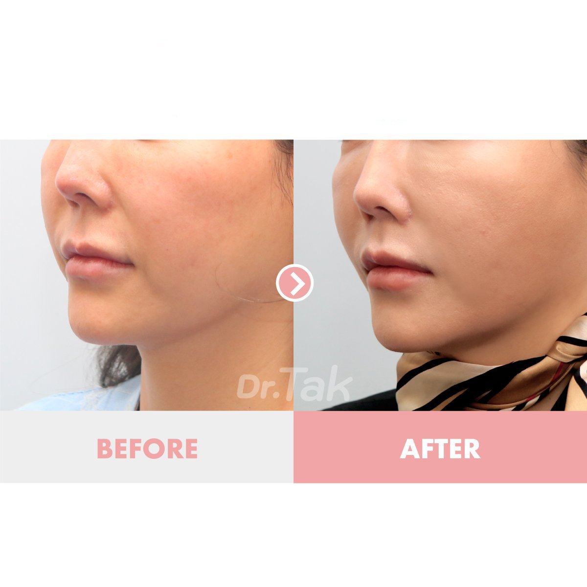 Before and after deep plane facelift results at Dr. Tak Plastic Surgery, facial rejuvenation