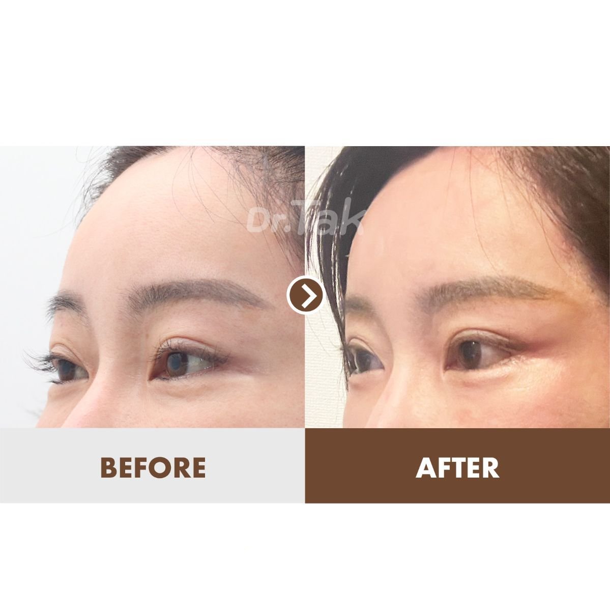 نتائج شد الجبهة قبل وبعد في عيادة Dr. Tak Plastic Surgery، رفع واضح للحاجب