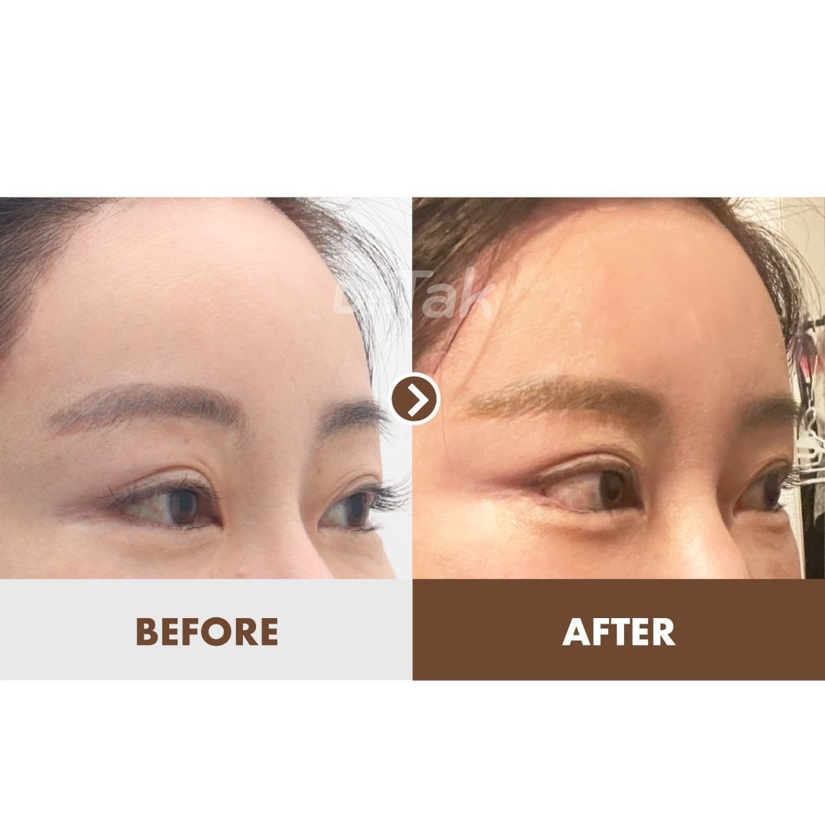 نتائج شد الجبهة قبل وبعد في عيادة Dr. Tak Plastic Surgery، رفع واضح للحاجب