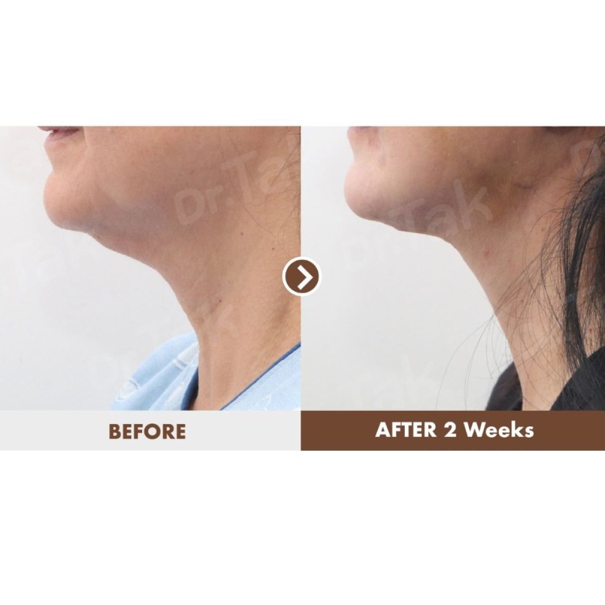 Resultados de lifting de cuello antes y después en Dr. Tak Plastic Surgery, mejoría tras 2 semanas