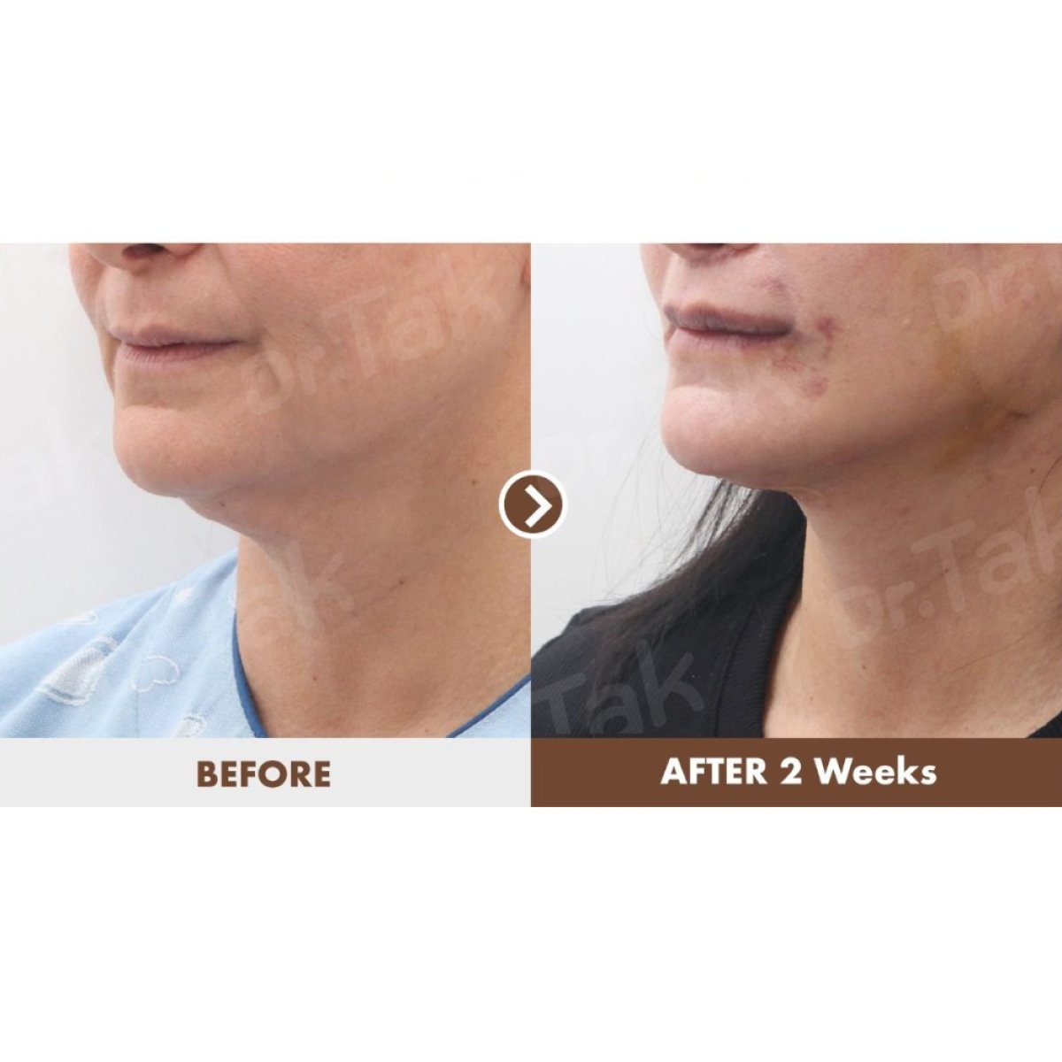 نتائج شد الرقبة قبل وبعد في عيادة Dr. Tak Plastic Surgery، تحسين واضح للكونتور