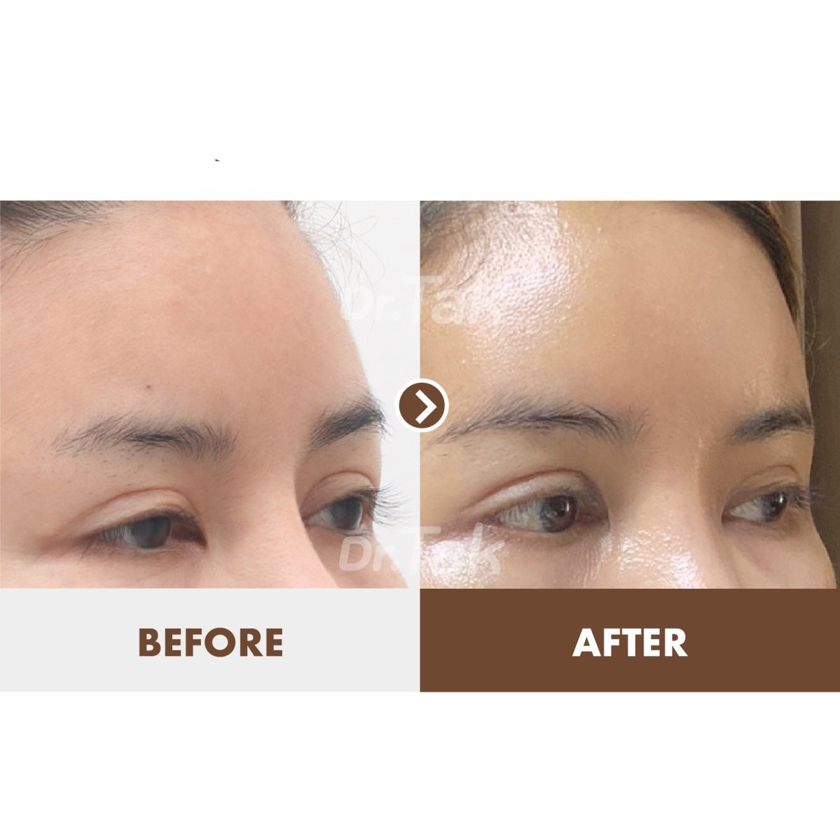 نتائج شد الجبهة قبل وبعد في عيادة Dr. Tak Plastic Surgery، جبهة أكثر نعومة
