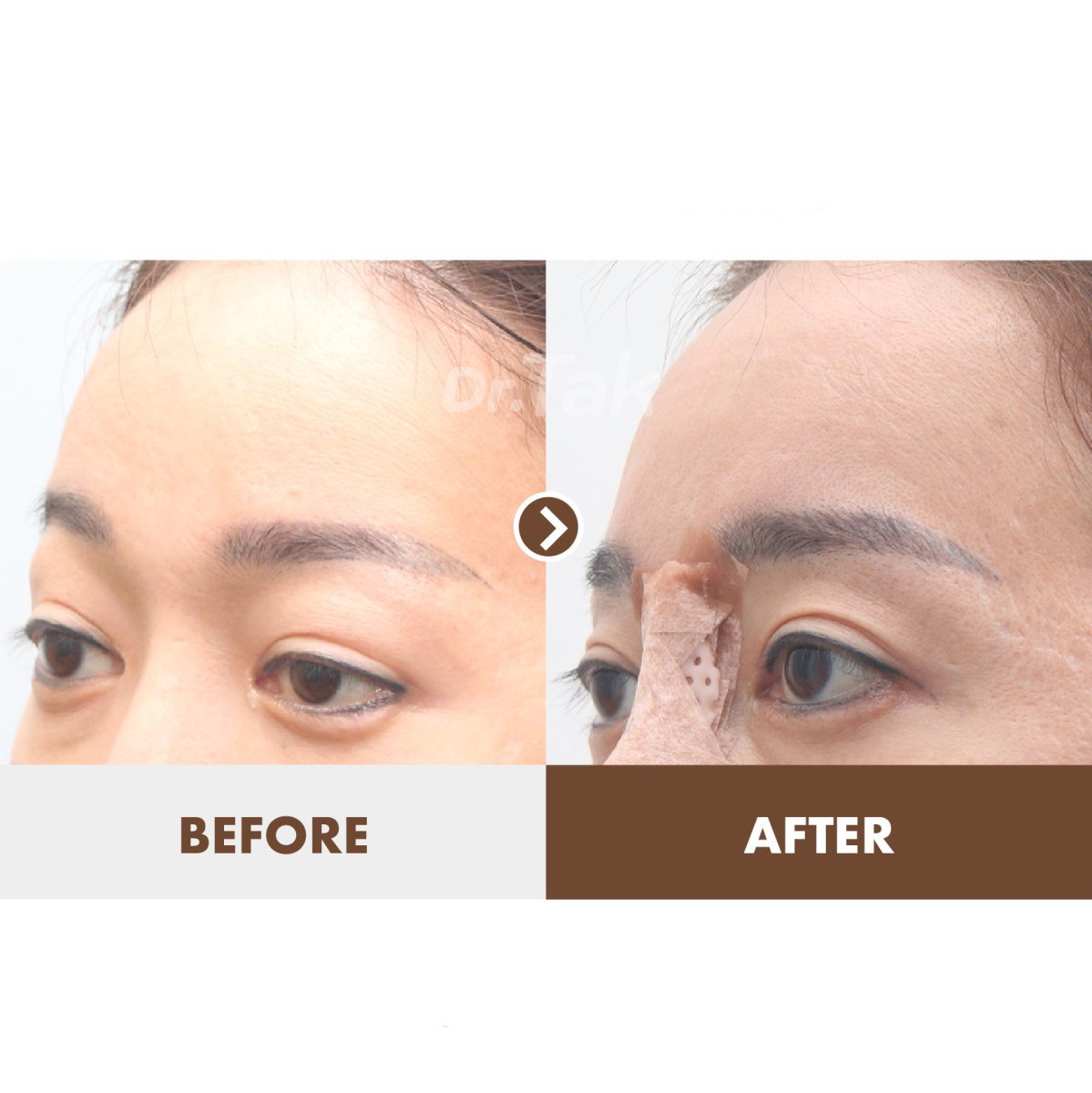نتائج شد الجبهة قبل وبعد في عيادة Dr. Tak Plastic Surgery، رفع الحاجب واضح