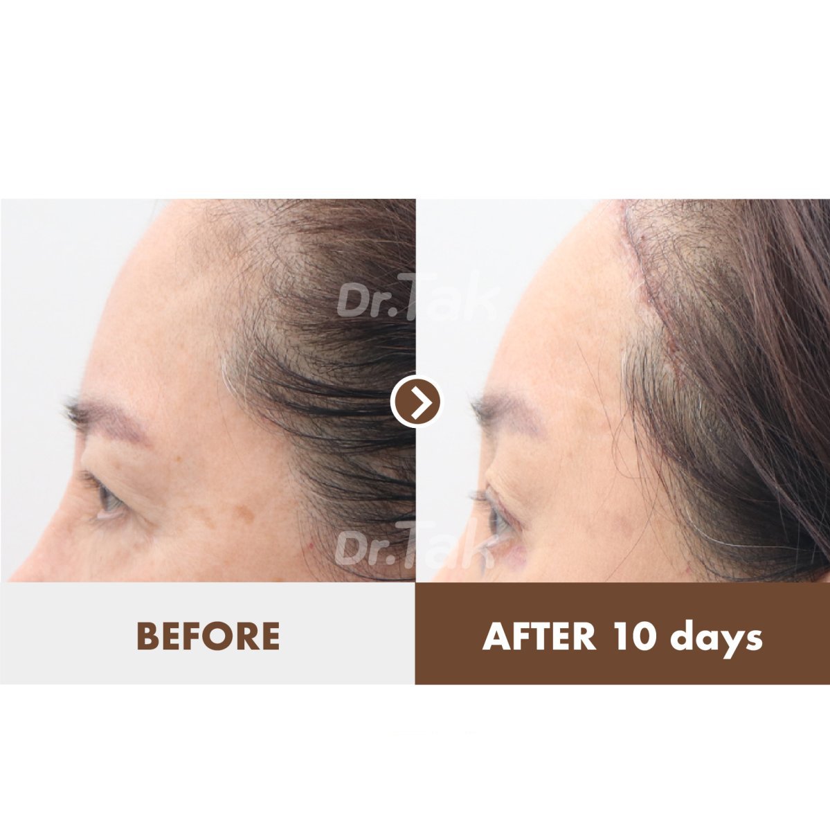 نتيجة شد الجبهة قبل وبعد 10 أيام في عيادة Dr. Tak Plastic Surgery، رفع واضح للحاجب