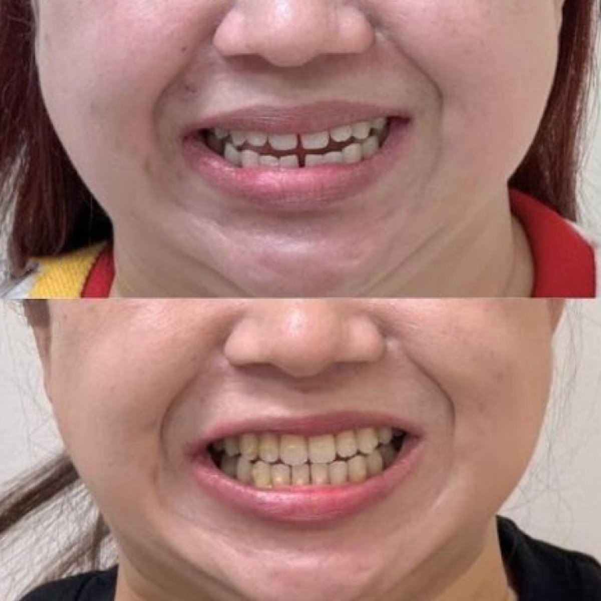 نتائج قبل وبعد تقويم Invisalign في Dentist at home بانكوك – تحسين انتظام الأسنان