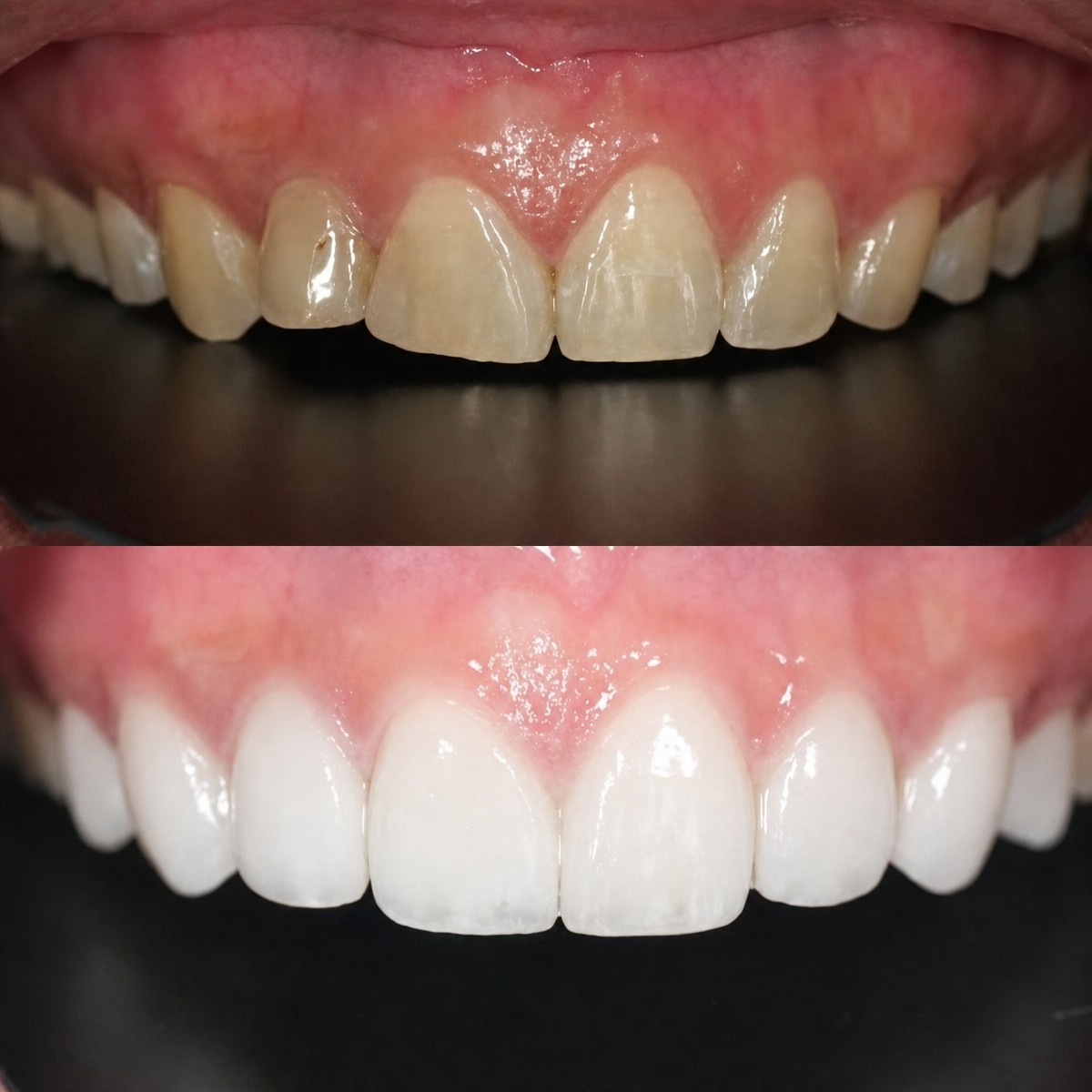 Vorher-nachher-Ergebnis Veneers bei Dentist at home Clinic, Chonburi – weiße, gerade Zähne