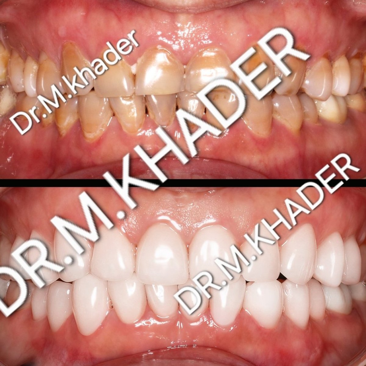 Before and after Emax veneers results at Wuhan Yiya Simei Dental Hospital, smile makeover