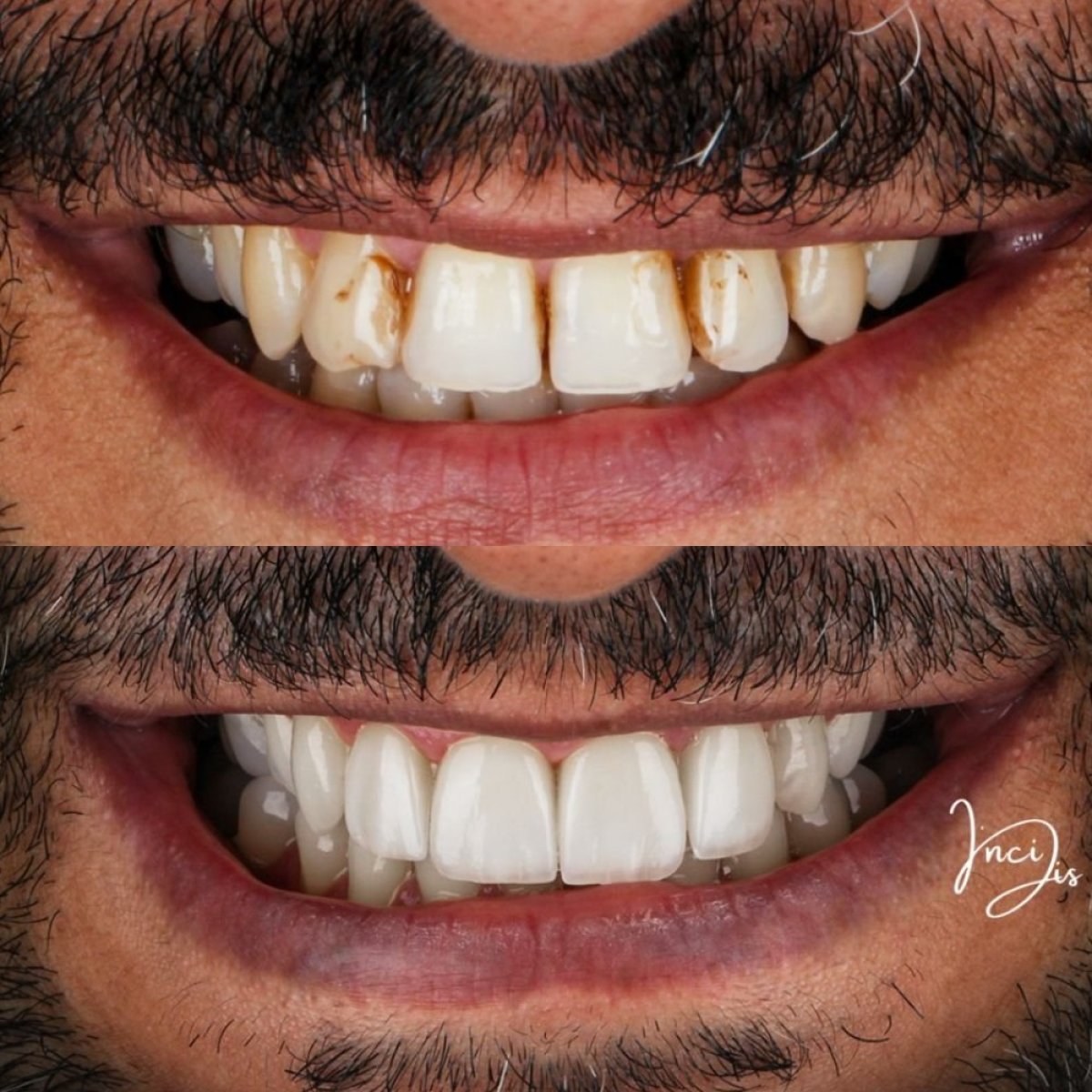 Before and after veneers at Inci Dis International, smile makeover with whiter teeth result