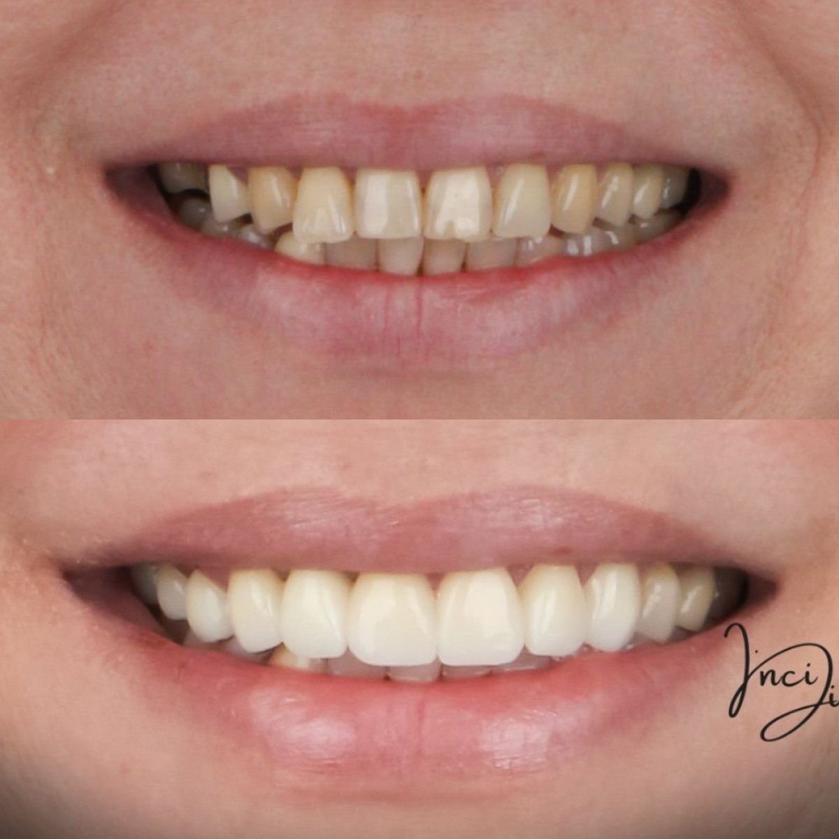 Antes y después de carillas dentales en Inci Dis International, sonrisa de aspecto natural