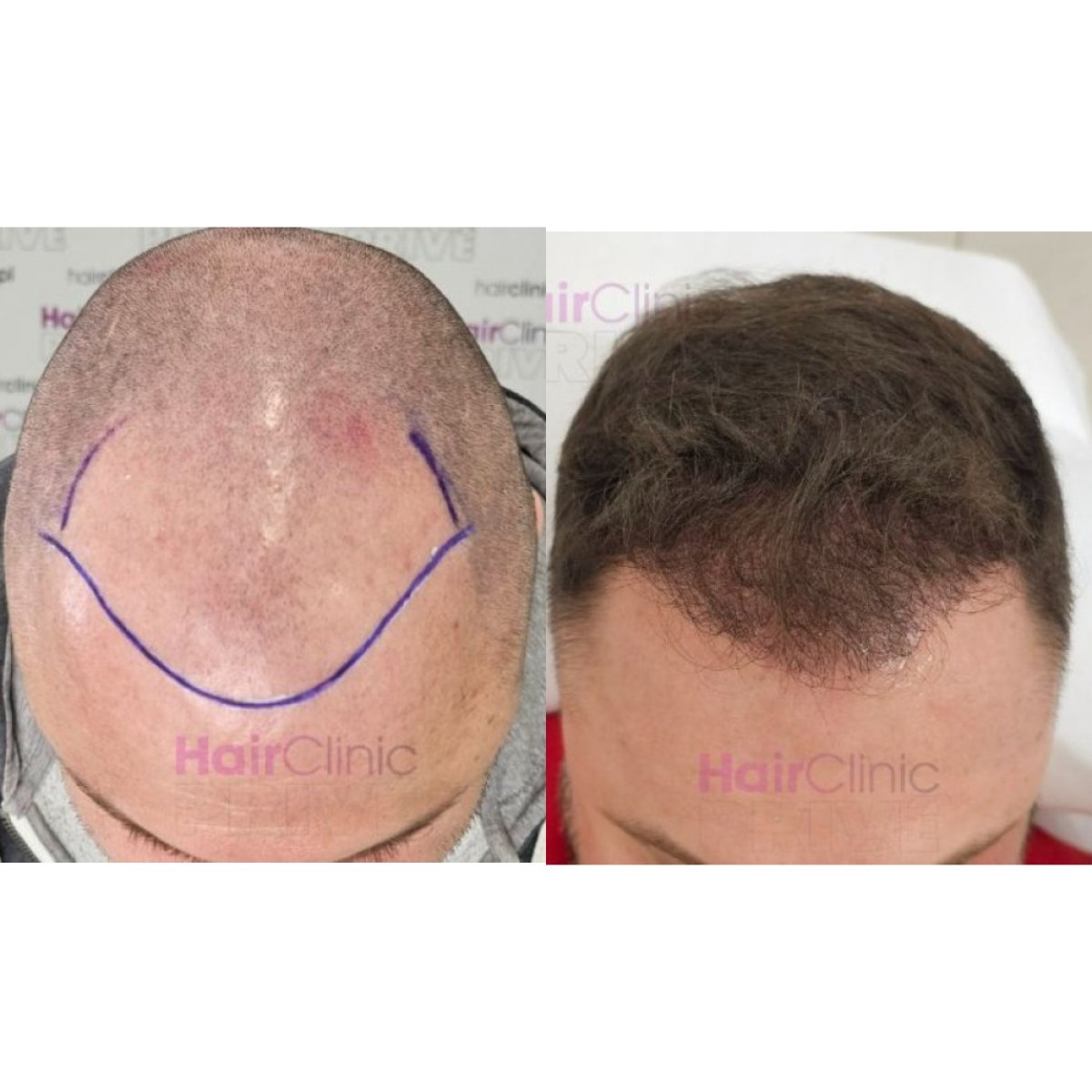 Результати до і після пересадки волосся FUE в Hair Clinic PRIVÉ, відновлена лінія волосся